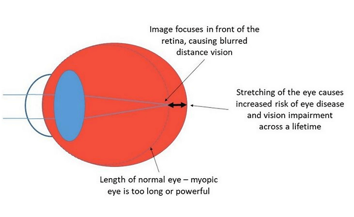 myopia explained diagram